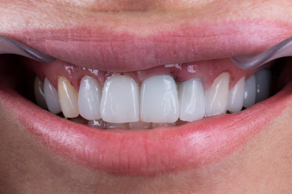 Can A General Dentist Repair A Dental Implant Restoration?